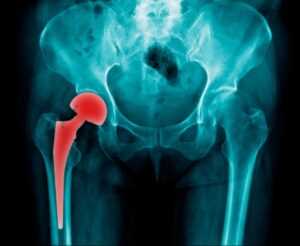 Hip Implant Recall Attorney