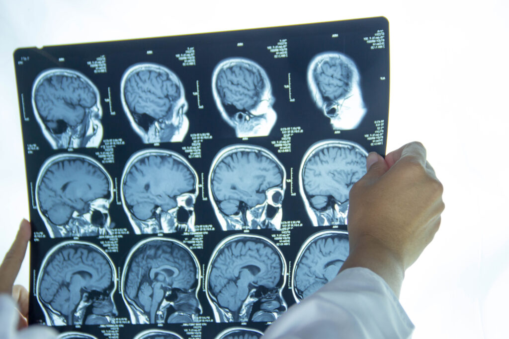 industrial injuries, TBI, SCI from construction site, refinery injuries and plant explosions